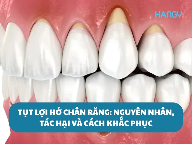Tụt lợi hở chân răng: Bật mí nguyên nhân, tác hại và cách khắc phục